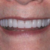 cosmetic dentist in Asheville, NC