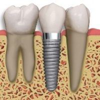 root canal in Asheville, NC