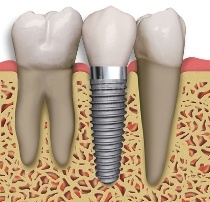 root canal in Asheville, NC